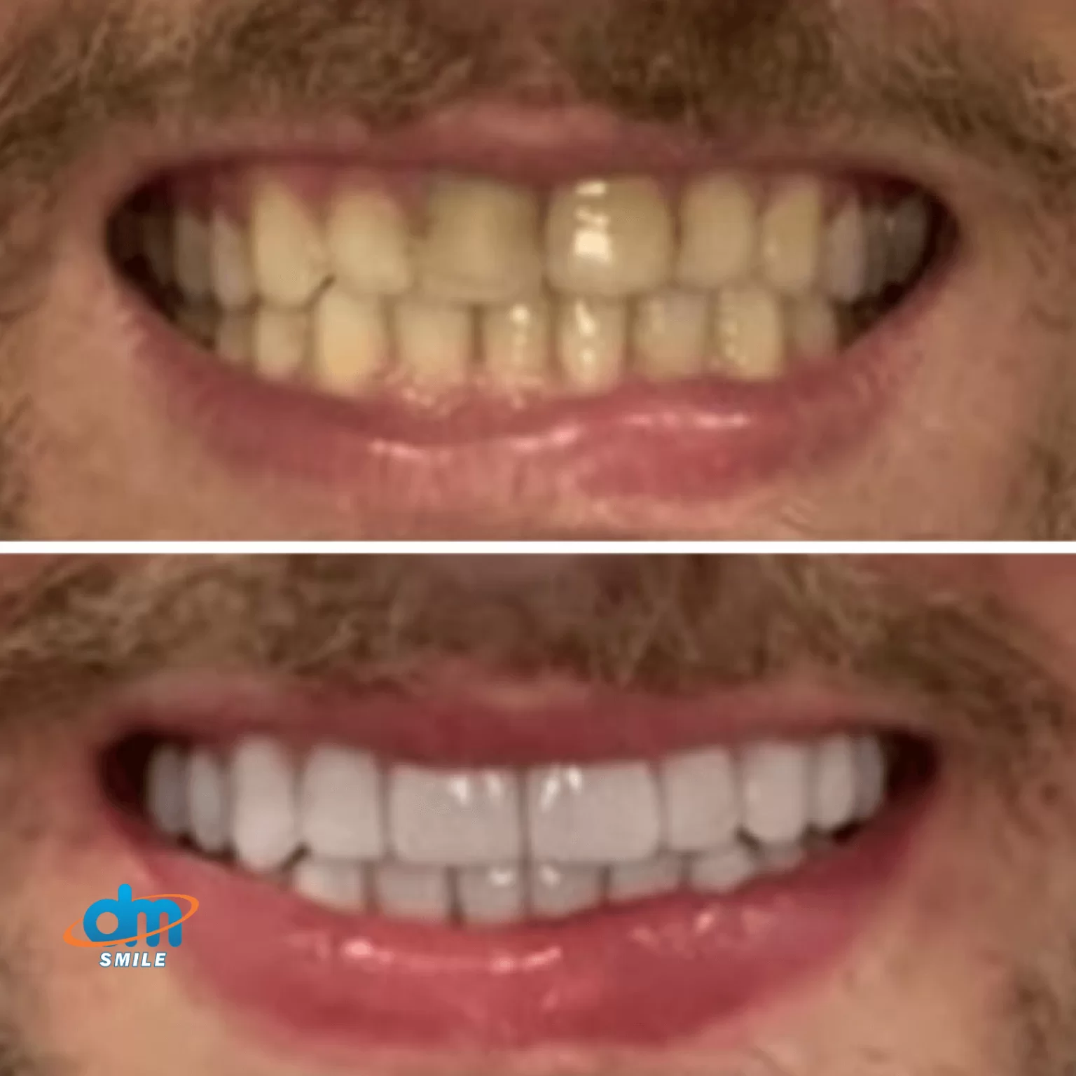 dr Marcelo Yamanaka - dentista em piedade 1 - lentes de contato dental 4