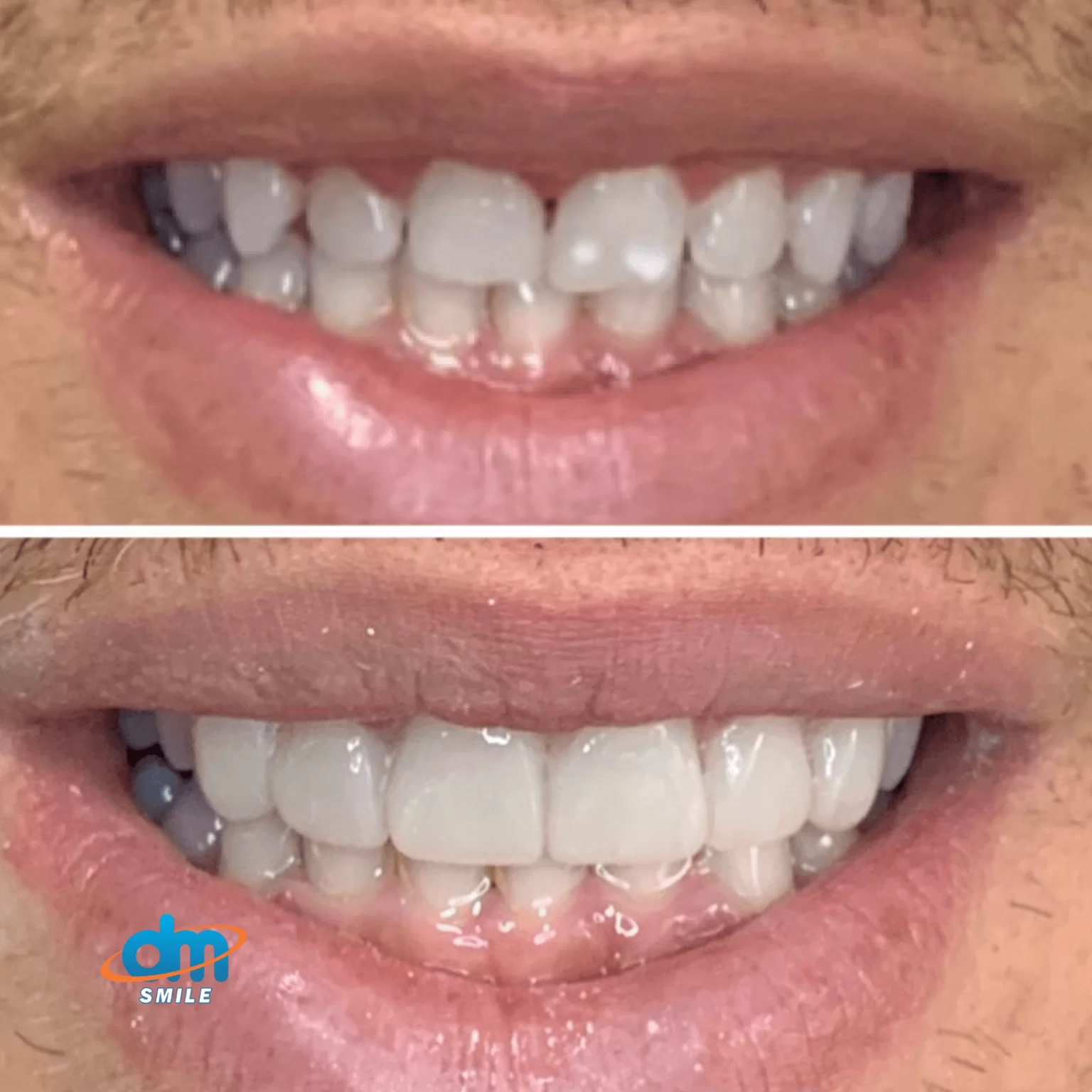 dr Marcelo Yamanaka - dentista em piedade 1 - lentes de contato dental 7